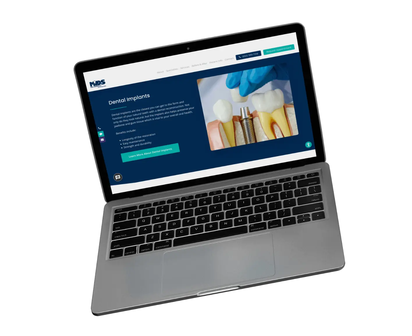 A laptop displaying a Mid Peninsula Dental Specialists website page about dental implants, featuring an image of dental implants and artificial teeth, along with informational text and navigation options.